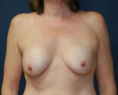 Feel Beautiful - Breast Revision San Diego 11 - Before Photo